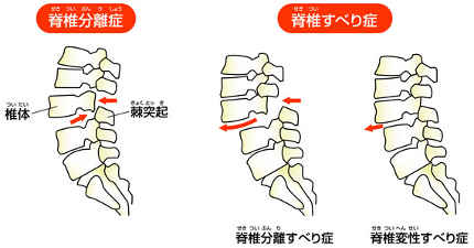 脊椎分離症／脊椎すべり症。背骨が離れたり、ずれたりして腰痛がおこる病気です。