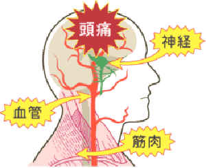 頭痛がおこる原因はさまざま。血管からおこる頭痛。筋肉や精神の緊張からおこる頭痛。脳や全身の病気から起こる頭痛などなど。片頭痛や群発頭痛、緊張型頭痛などの慢性頭痛が大半を占めます。