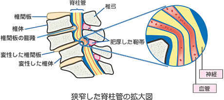腰部脊柱管狭窄症。腰椎の脊柱管が狭くなって脊髄（神経）を圧迫します。