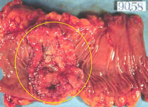大腸がん（結腸がん）の病理写真
