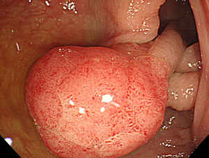 内視鏡で撮影した大腸ポリープ